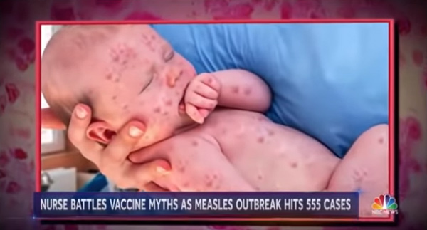 Measle-infected baby photos FAKED by NBC News to push mass hysteria and demand vaccine compliance
