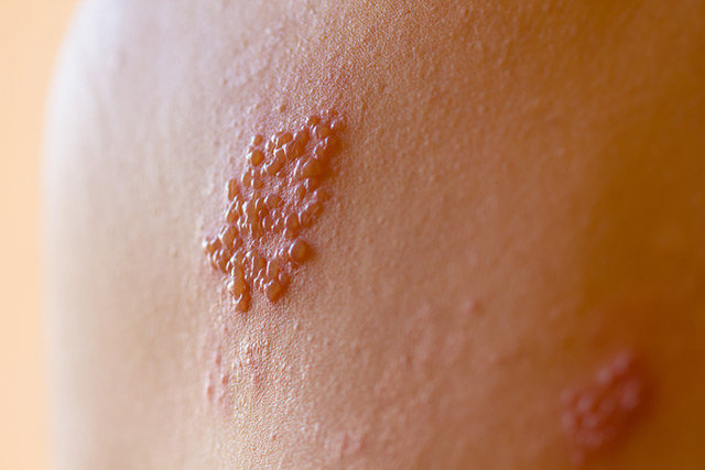 Shingles vaccine responsible for causing huge number of shingles cases, vaccine injuries