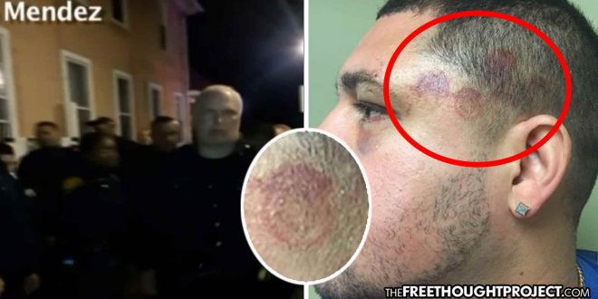 Cops Beat Man for Filming Them Abuse His Mom, Leave Badge-Shaped Scars All Over His Body