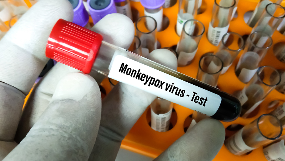 Monkeypox is a coverup (distraction?) for covid “vaccine” adverse events, including AIDS